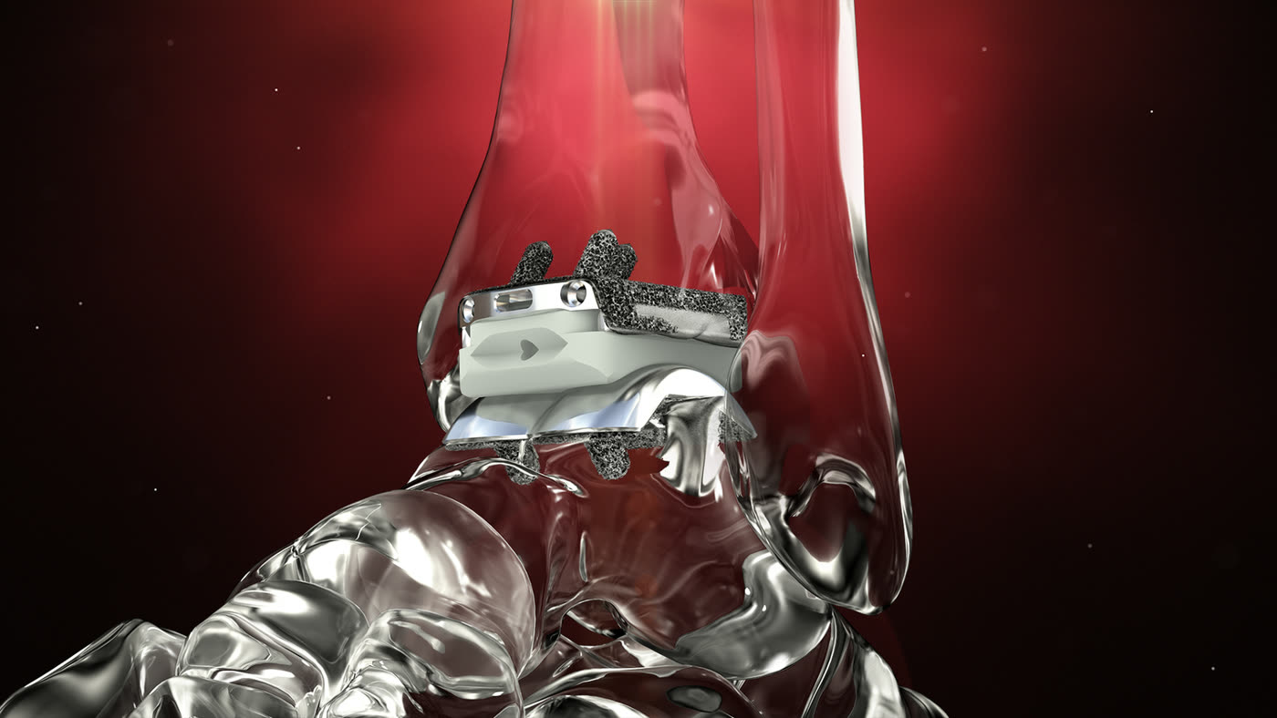 Cardiac Device Launch | Design A Fixture