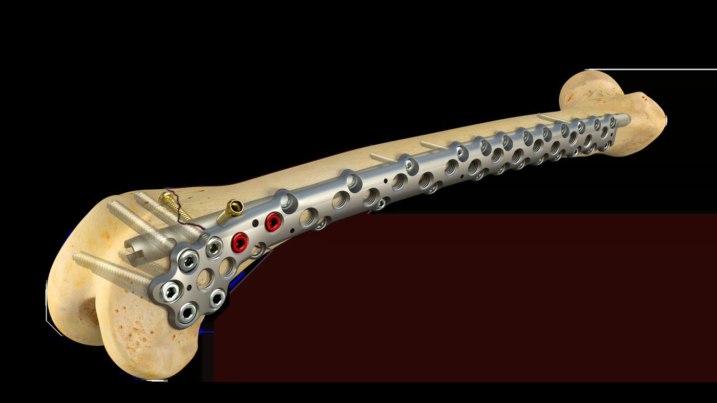 Surgical Technique Series | Design A Fixture